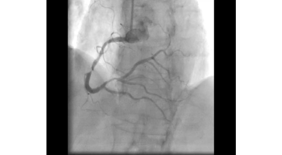 Coronary Angiography Dr David Brull vrogue.co